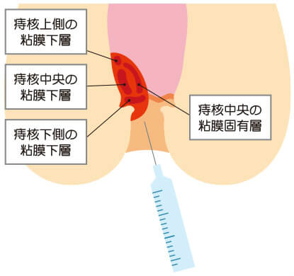注射 後遺症 ジオン