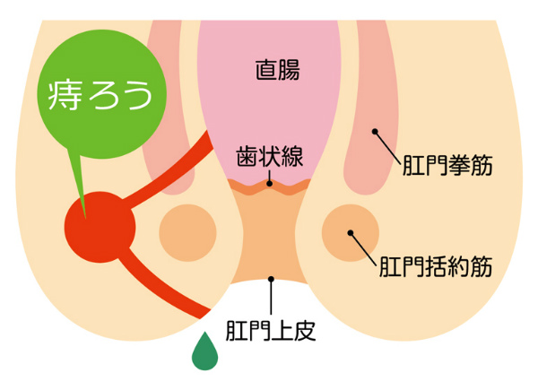 痔ろう（あな痔）について