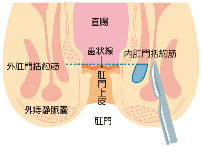 側方皮下内括約筋切開術（LSIS）