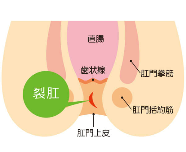 おしりから血がでた 血便の原因と治療法 おおさわ胃腸肛門クリニック