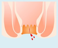急性裂肛