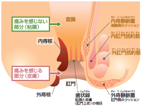 方 切れ 痔 治し 切れ痔は放置しても治らない。早期対策がなによりも重要な理由