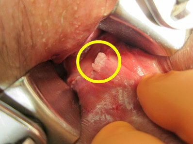 肛門管内に発生したコンジローマ