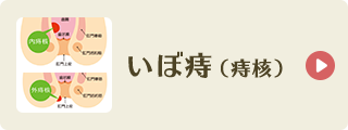 いぼ痔（痔核）