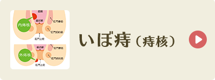 いぼ痔（痔核）