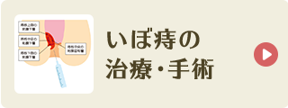 いぼ痔の治療・手術