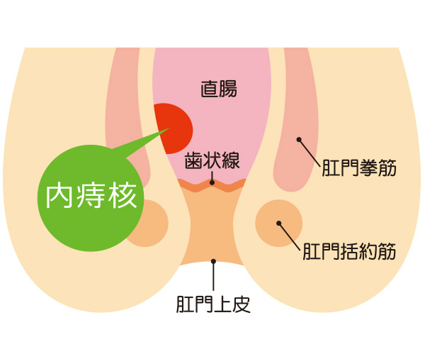 いぼ痔 痔核 の原因 治療 手術 おおさわ胃腸肛門クリニック