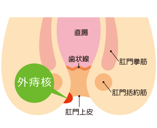 いぼ痔（外痔核）