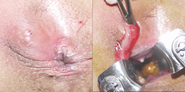 肛門周囲膿瘍